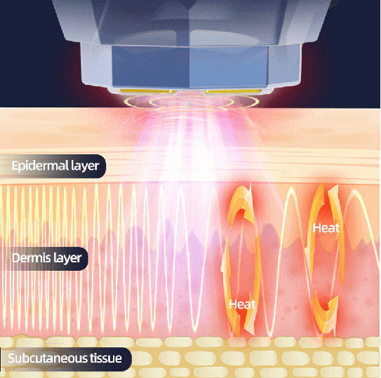 Unveiling the Science and Effects of Home Radiofrequency Skin Tightening